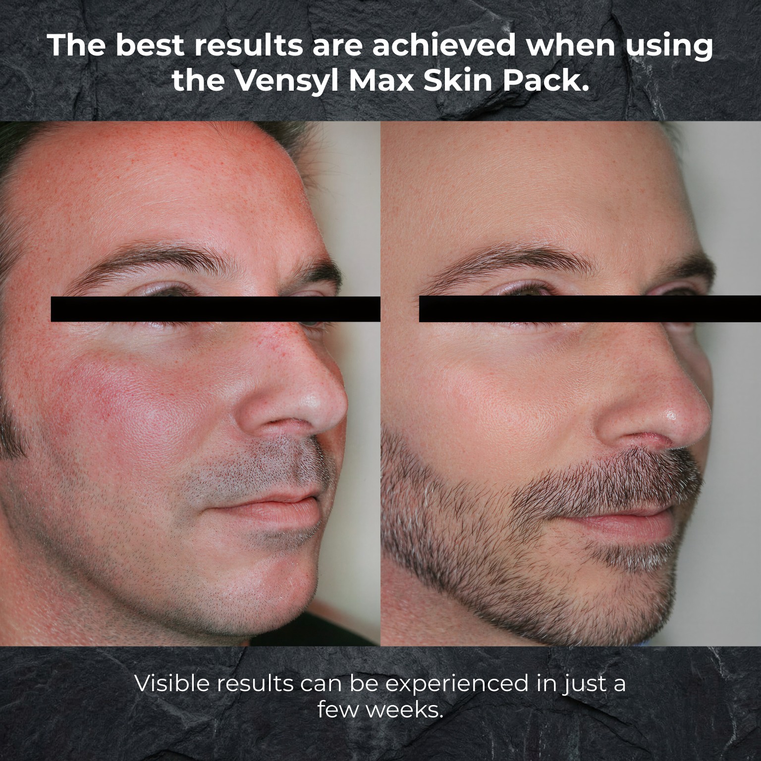 Before and after comparison of skin using Vensyl Max Skin Pack